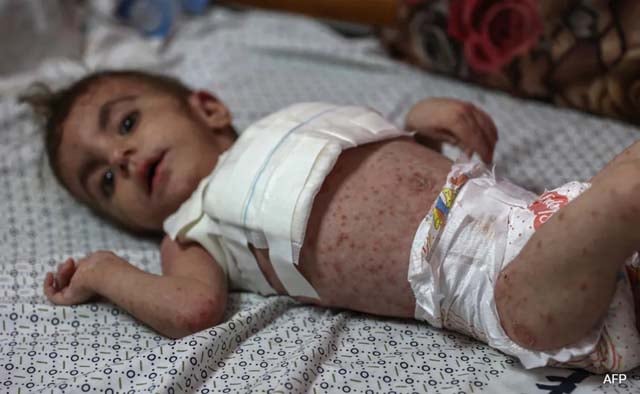 Dangerous skin diseases spreading among Gaza children
